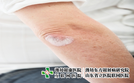 攝圖網_321241037_絲蟲病皮膚或決定肘肘（企業商用）