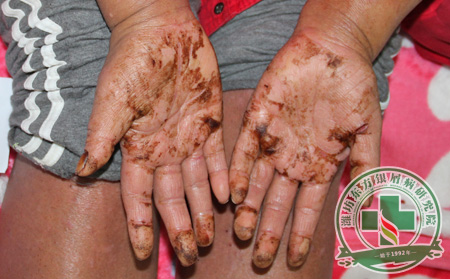 關節病性銀屑病反復發作的病因