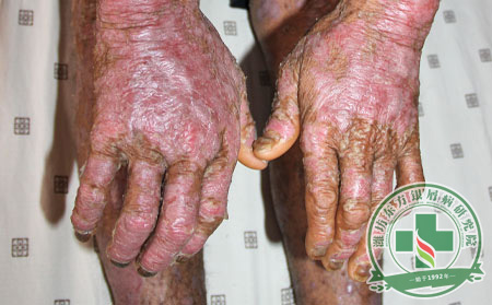 女性會患關(guān)節(jié)病性銀屑病的原因