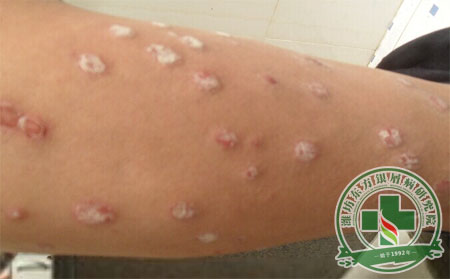 銀屑病平時(shí)注意什么