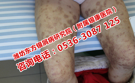 治理想膿皰型牛皮癬得花很多錢嗎