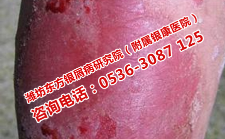 牛皮癬為什么要護(hù)理