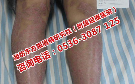 如何防治紅皮型銀屑病