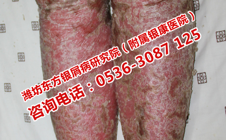 銀屑病的專業(yè)護理