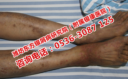 牛皮癬患者在日常應該注意什么