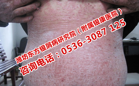 有什么方法治牛皮癬