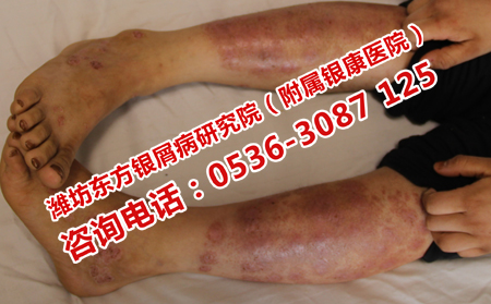 老人牛皮癬頻繁復發的原因