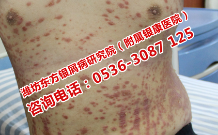 濰坊牛皮癬醫(yī)院回怎樣治療牛皮癬