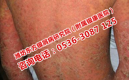 治療男性牛皮癬