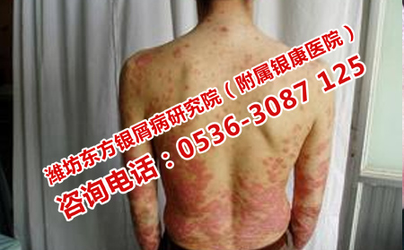 牛皮癬患者如何清淡飲食