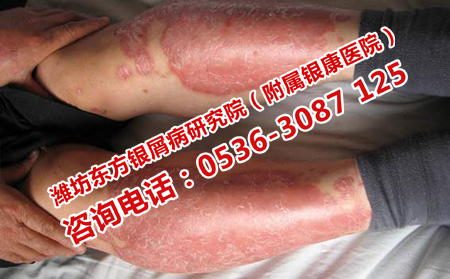 牛皮癬的治療技術