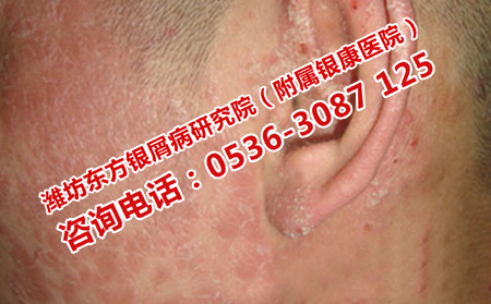 治療牛皮癬醫(yī)院理想不理想