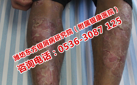 牛皮癬患者日常應(yīng)該注意什么問題