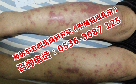 治療牛皮癬怎么做