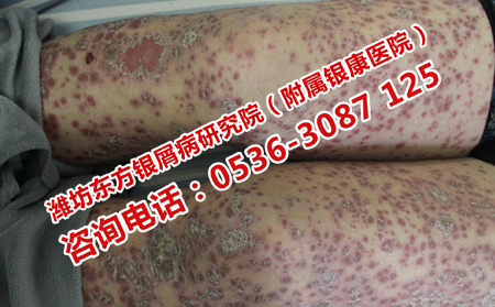 青少年牛皮癬患者吃點(diǎn)什么比較理想