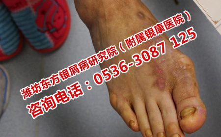 牛皮癬患者的哪些食物不能吃