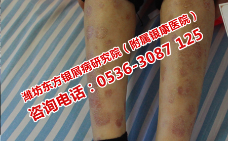 孕婦為什么會得牛皮癬