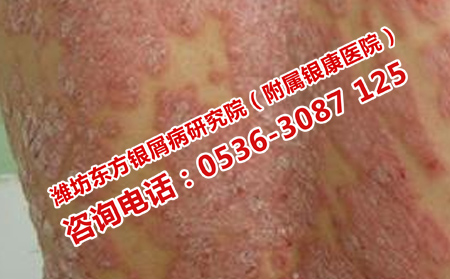 牛皮癬患者適合哪種飲食方式