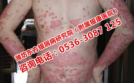 哪家醫(yī)院的牛皮癬療法理想