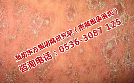 牛皮癬能不能有效治理想