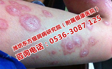 如何預防牛皮癬復發(fā)