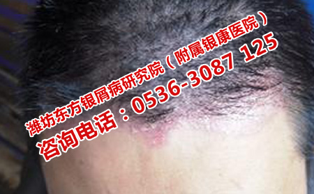 頭部牛皮癬理想轉的方法