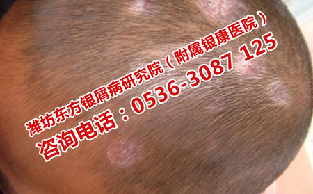 兒童牛皮癬的癥狀