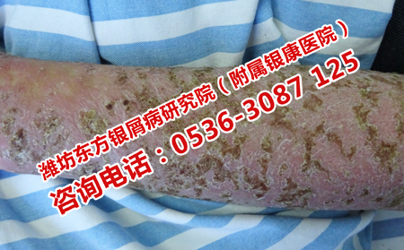頑固老人銀屑病的治療