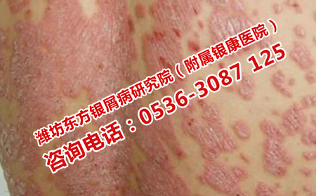 濰坊牛皮癬哪里理想