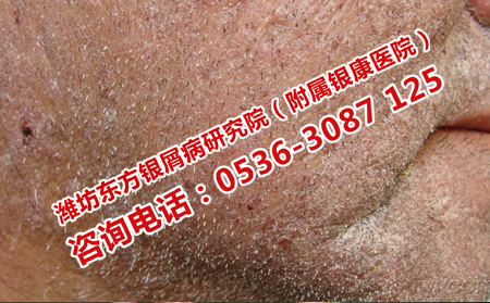 濰坊銀屑病醫(yī)院的理想的療法