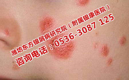 安丘理想點(diǎn)的銀屑病醫(yī)院