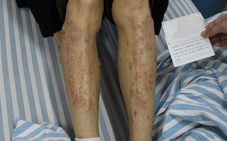 治療銀屑病理想的?？漆t院