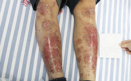 生活中如何護理銀屑病呢