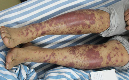 關節型銀屑病的春夏護理