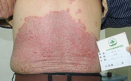 銀屑病為何加重