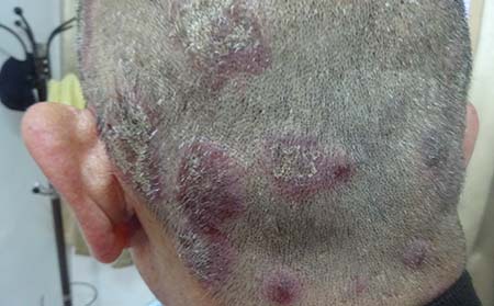 男性牛皮癬,濰坊東方銀屑病研究院,濰坊哪所醫院看銀屑病效果好