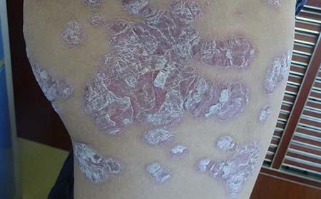 濰坊銀屑病好醫院銀屑病護理