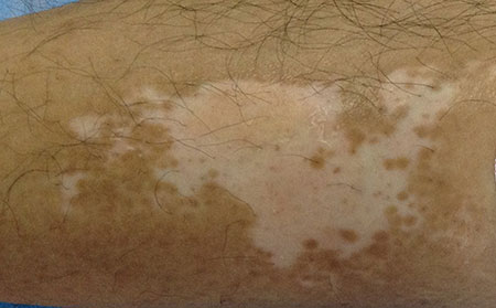 濰坊皮膚病醫院排名