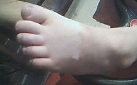 預防白癜風,預防白癜風方法