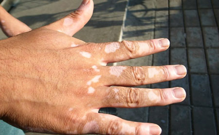 預防白癜風,預防白癜風發作,濰坊白癜風醫院