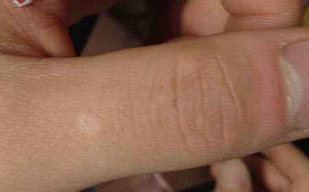 白癜風治不好,白癜風治療,濰坊白癜風醫院