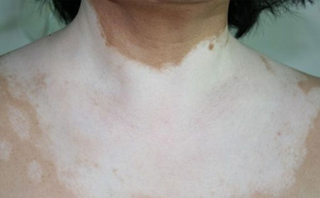 白癜風治療,治療白癜風藥物,白癜風外用藥