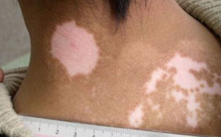 白癜風怎么區別,汗斑