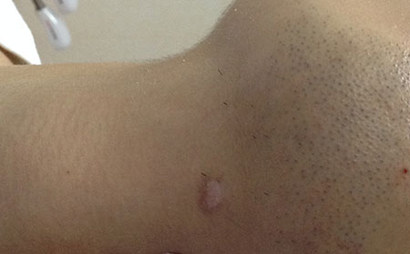 白癜風(fēng)發(fā)病原因,白癜風(fēng)發(fā)病人群