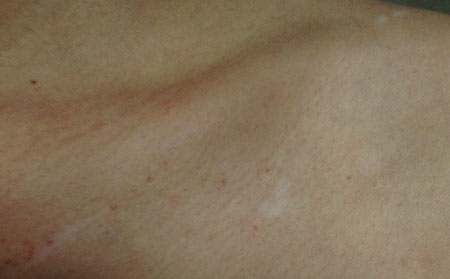 夏季白癜風,白癜風如何護理