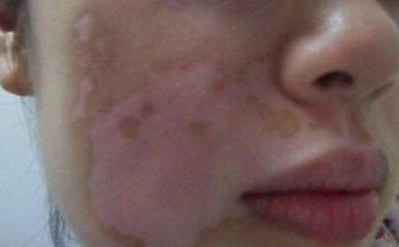 白癜風的癥狀,白癜風的癥狀表現