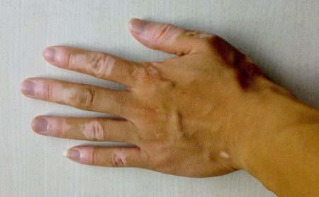 白癜風發(fā)病原因,患上白癜風原因