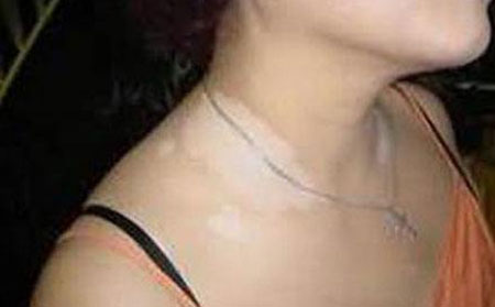 上班族怎么有效的預防白癜風