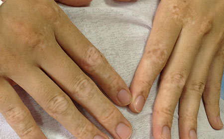 白癜風復發,預防白癜風復發