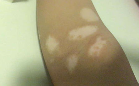 白癜風癥狀,白癜風癥狀分辨